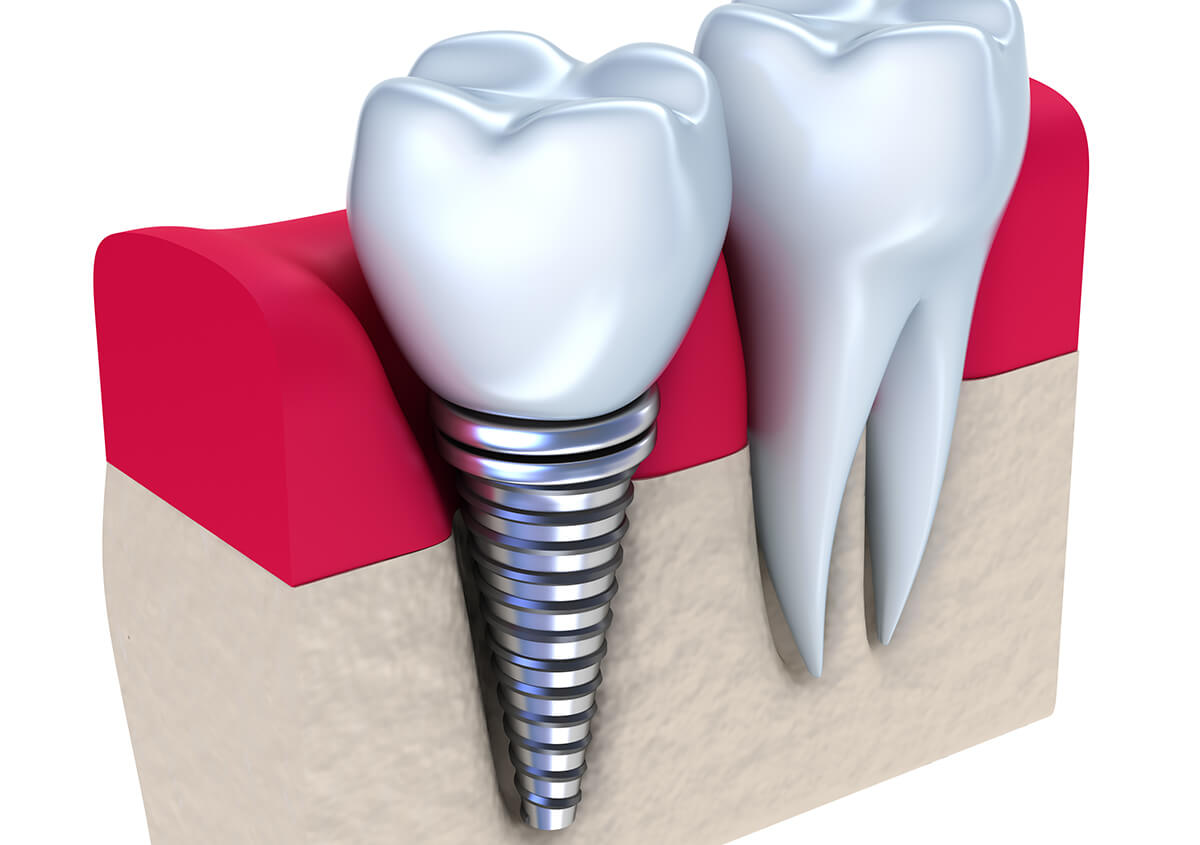 Affordable Dental Implants in La Mesa Area